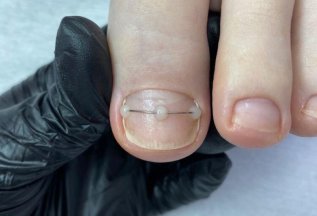 Коррекция вросших ногтей титановой нитью