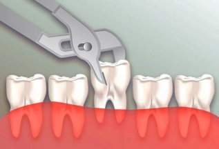Бесплатное удаление зубов при имплантации!