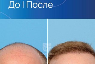 ПЕРЕСАДКА ВОЛОС