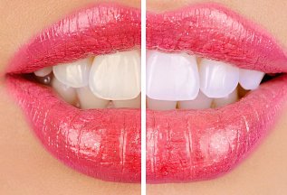 Отбеливание зубов Amazing White (США)