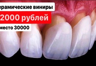 Керамические виниры 22000 рублей