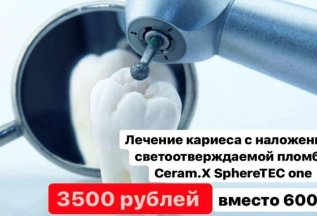 Лечение кариеса 3500 рублей