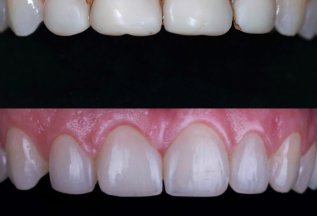 Эстетическая реставрация зубов композитными винирами