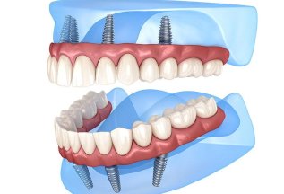 Лучшее предложение на имплантацию ALL-on-4
