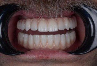 Имплантация Все на 4 — замена всех зубов