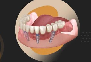 Имплантация протезирование зубов ALL ON 4