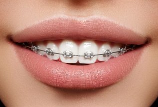 Исправление прикуса и выравнивание зубов за 10 месяцев