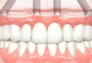 All-on-4 имплантация зубов за один день - 205 000 