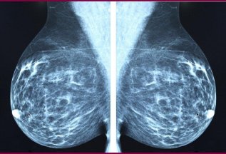 Цифровая маммография всего за 1700 руб. (Скидка 19%)