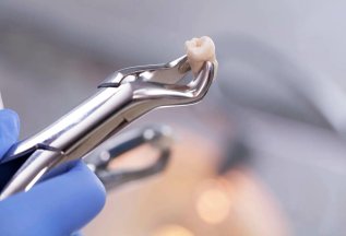 Удаление зубов со скидкой 10%