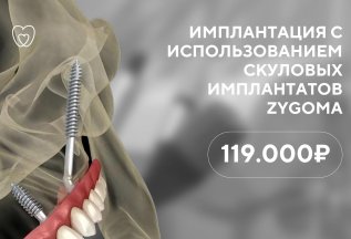 Внутрикостная имплантация Zygoma (Зигома)
