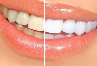 Отбеливание зубов Opalescehce Boost