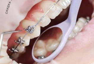 Скидка на ортодонтические лечение