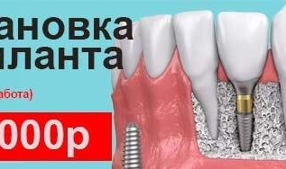 Установка импланта под ключ - 19 000 рублей!