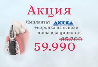 Имплантация зубов под ключ ASTRA