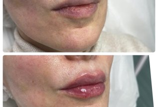 Коррекция объёма и симметрии губ