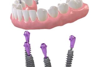 Восстановить все зубы в челюсти на 4х имплантатах от 115тыс.