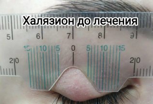 Халязион верхнего и нижнего века