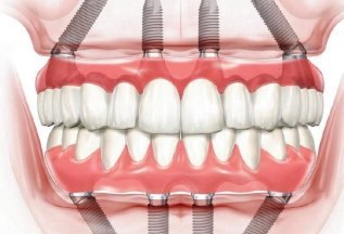 Тотальное протезирование зубов «Всё на 4» от 7000 руб. в мес