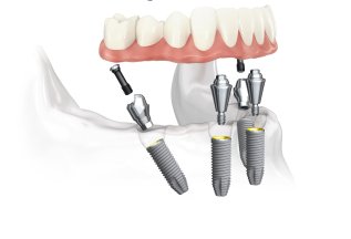 Восстановление зубов методом All on 4 