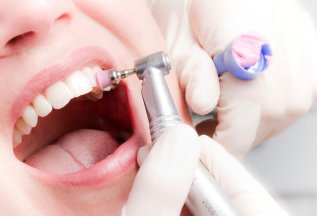 Скидка 15% на гигиену полости рта перед имплантацией зубов