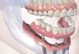 Имплантация зубов с имплантатом «Осстем» -не дорого
