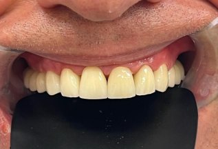 Художественная реставрация зубов без обточки