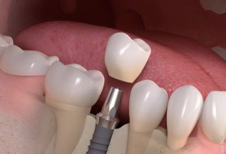 Имплантация зубов с Штрауманн - реальная цена