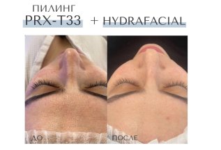 HydraFacial — расширенный протокол для лица и шеи
