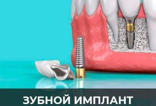 Каждый четвертый имплант за 10 000 рублей 🔥