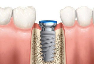Акция на имплантацию зубов