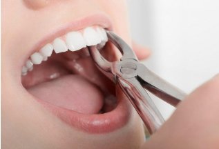 Удаление зубов для взрослых