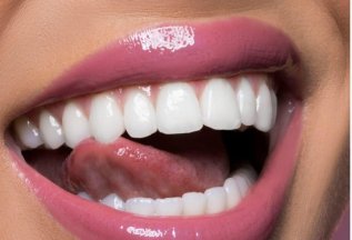 Отбеливание зубов системой Opalescence Boost - 15000 руб