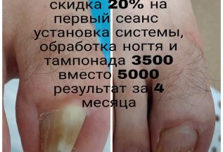 Титановая нить и обработка ногтя - 30%