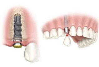 Имплант зуба за 9 900 ₽ (АКЦИЯ - 50%)