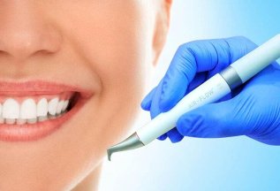 Профессиональная чистка в ПОДАРОК при имплантации зубов