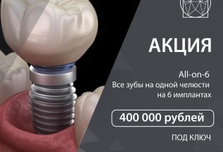 All-on 6 все зубы на одной челюсти 400000 рублей под ключ