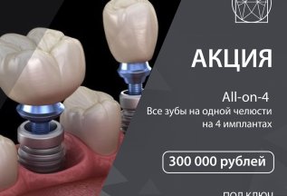 All-on 4 все зубы на одной челюсти 300000 рублей под ключ