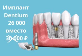 Имплант Dentium за 26 000 вместо 30 000 рублей!