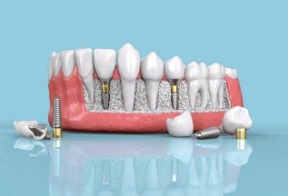 Премиальная имплантация зубов Dentium под ключ за 38 500
