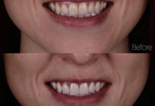 Отбеливание зубов Flash + гигиена + индивидуальные каппы