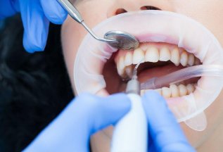 Чистка зубов или прием остеопата в подарок