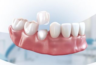 Коронка из диоксида циркония со скидкой 10%
