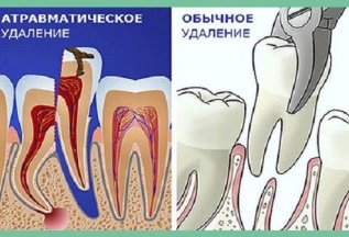 Лучшее предложение Атравматическое удаление зубов