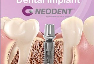 Установка имплантата Neodent с циркониевой коронкой за 57900