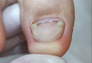 Установка коррекционной системы, что дальше?