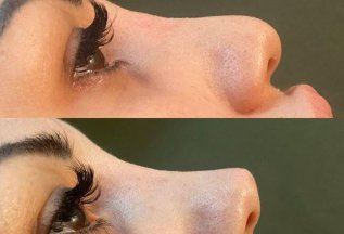 Акция‼Ринопластика 10000₽ Без операций, боли, отёков и др