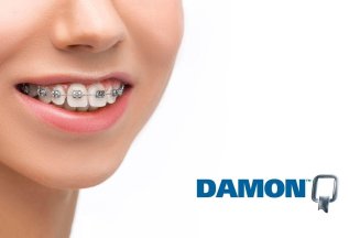 Брекет-система Damon Q на одну челюсть 40.000 ₽