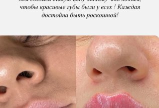 Увеличение губ