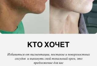 Удаление пигментации